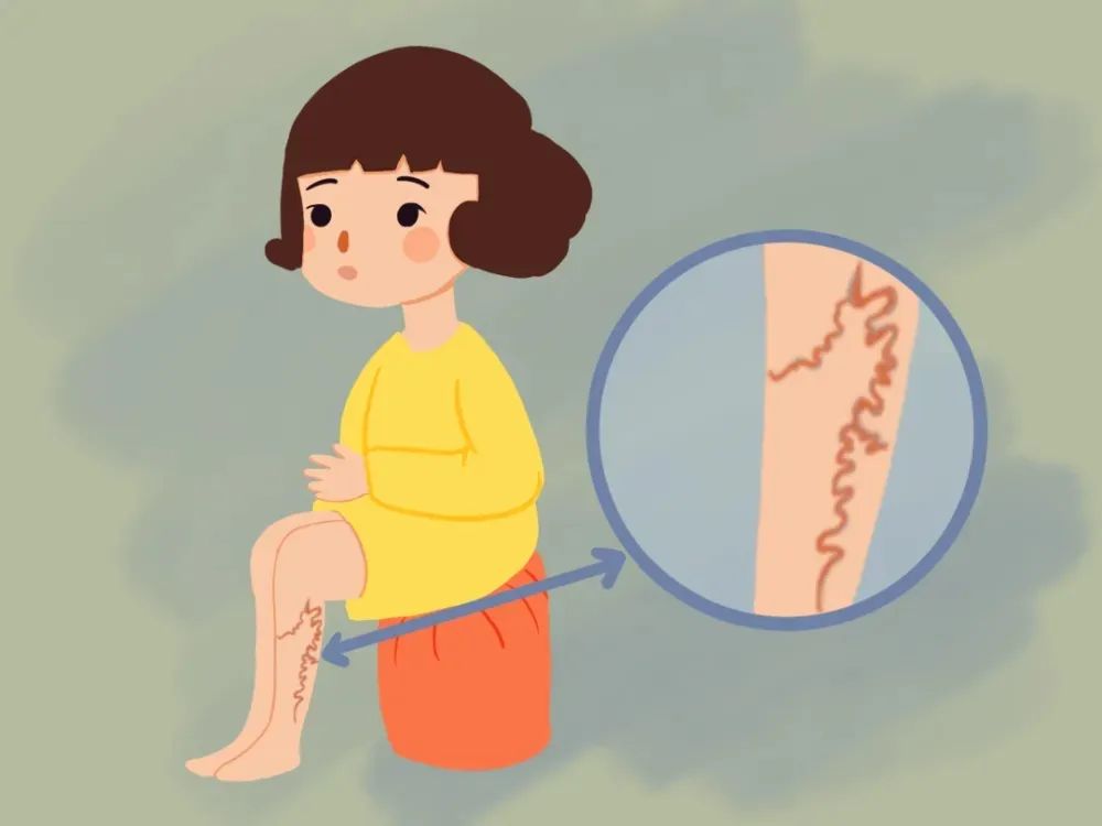 神奇！打针就能治好静脉曲张，这个白泡泡秒杀“小蚯蚓”
