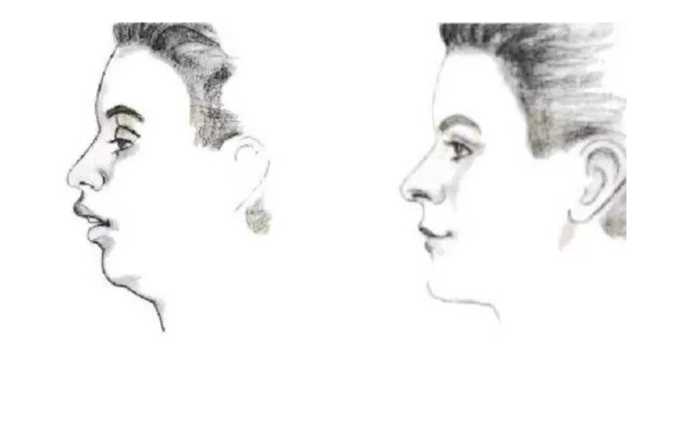 下巴短和后缩怎么变美,下巴后缩怎么矫正嘴尖