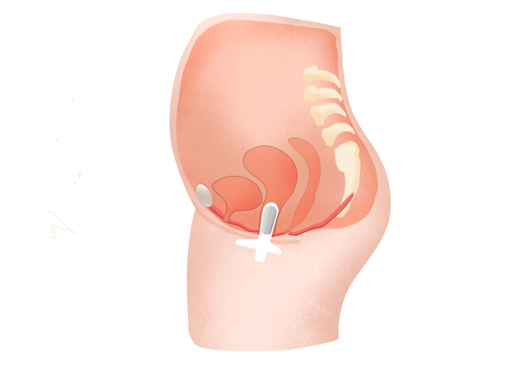 本来不漏尿的盆底肌修复后漏尿,盆底康复训练器漏尿