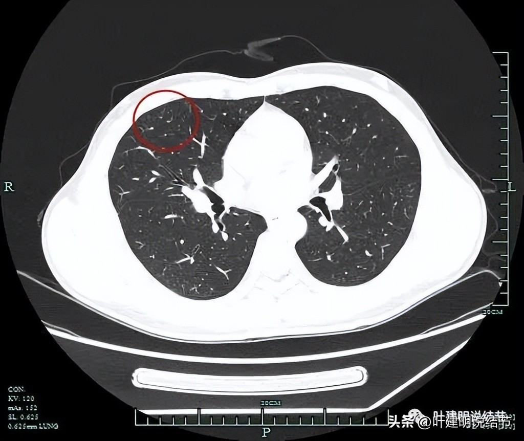 中叶多发微小结节,男性30岁右侧甲状腺单发结节