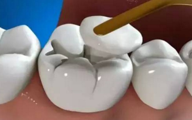 补牙材料掉了一部分怎么处理,补牙材料脱落怎么补