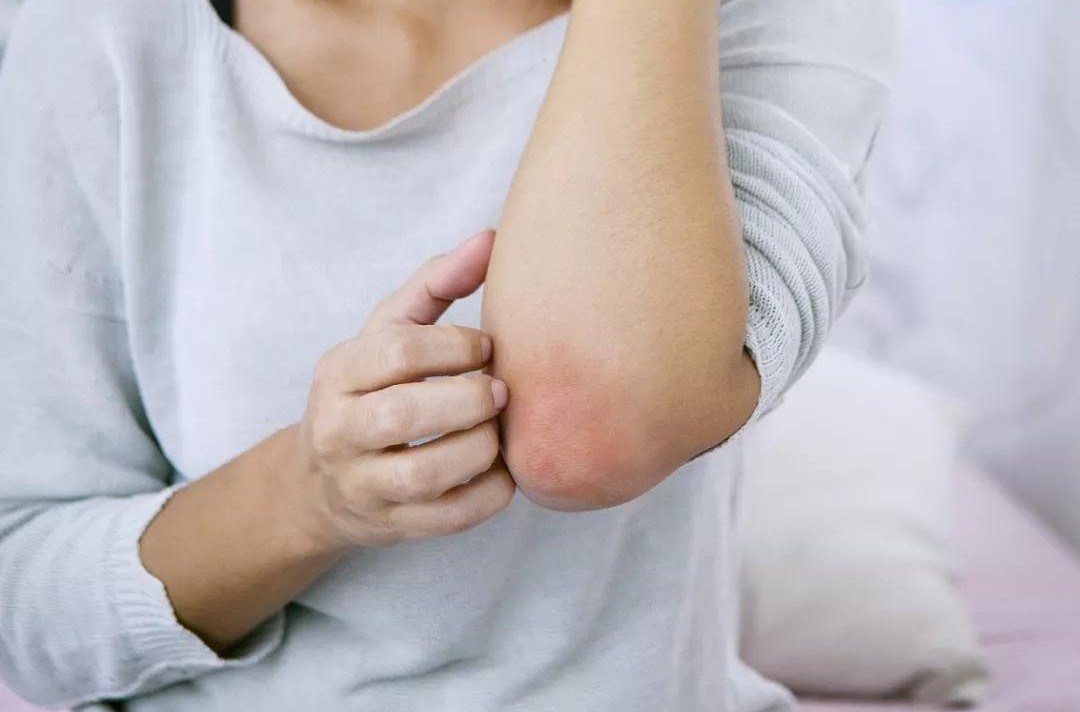 女子身上长虫医生拿镊子治疗,女子体内有蜱虫被医生拿镊子拔出