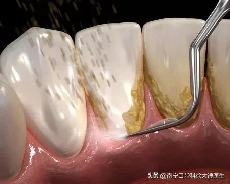 怎么治牙周病最好特别有效,牙医教你如何医牙