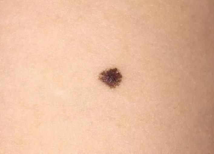 长在什么位置的痣易癌变,身上的痣出现4个变化引起重视