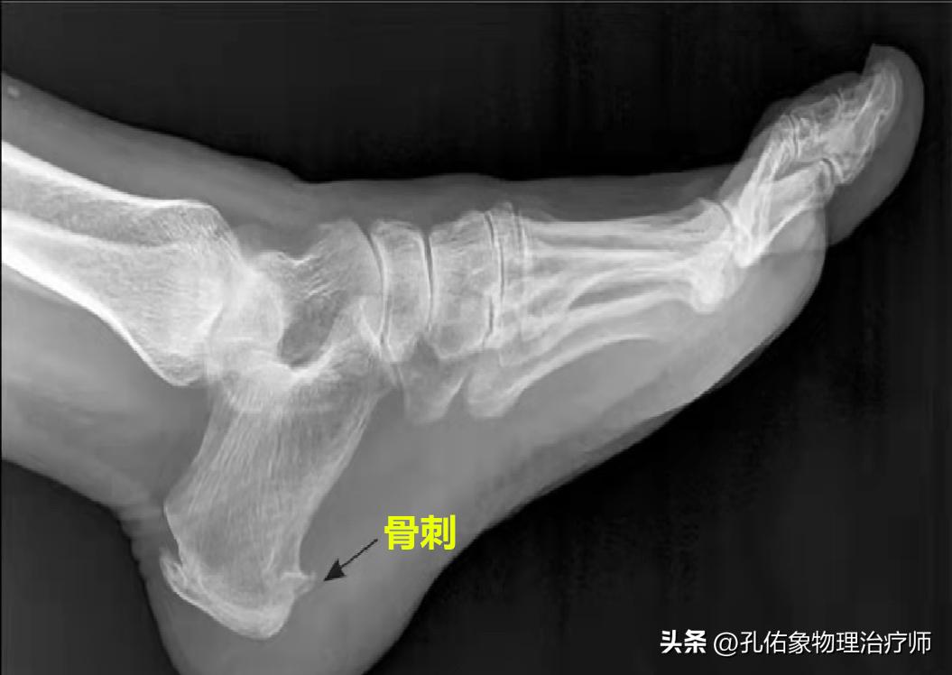 脚部信号透露健康问题,脚部出现这6种症状