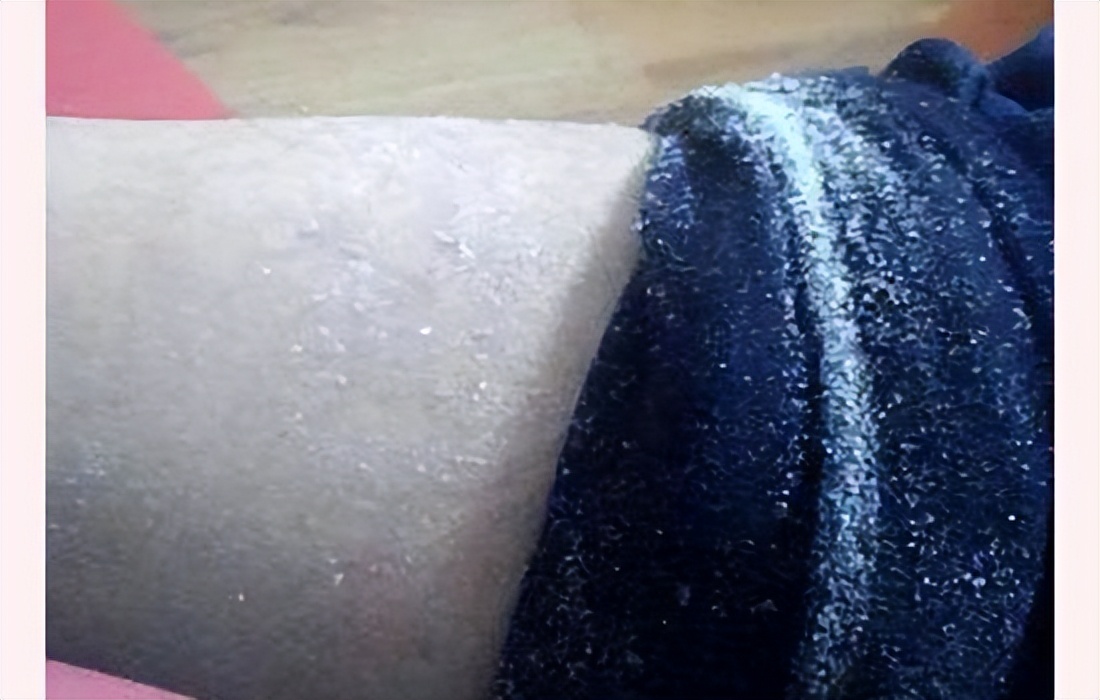 冬天身体干燥起皮屑怎么办穿什么,冬天一脱秋裤皮屑满天飞怎么办