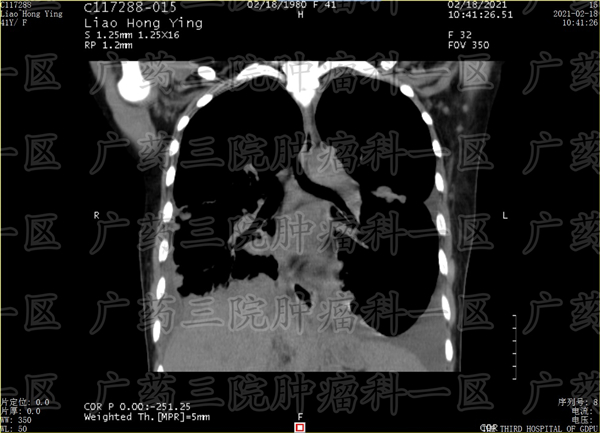 乳腺癌水肿溃烂自愈案例,乳腺癌软组织多处转移溃烂