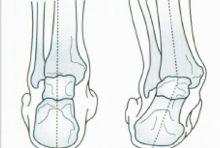成人初期扁平足可以干预吗,两岁足外翻扁平足康复训练