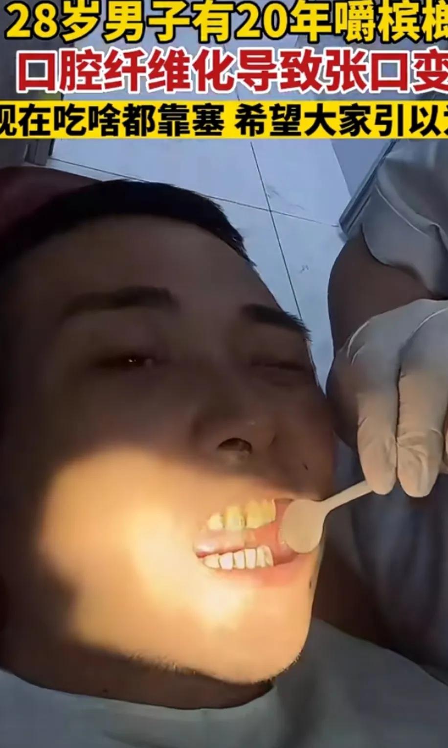 每天嚼5包槟榔连续吃10年,小伙一天吃一包槟榔恶心想吐