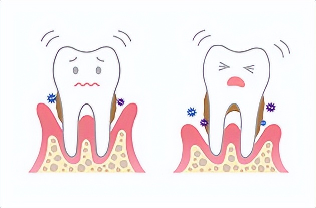 牙龈出血牙齿松动最佳补救方法,牙龈出血牙齿松动怎么办