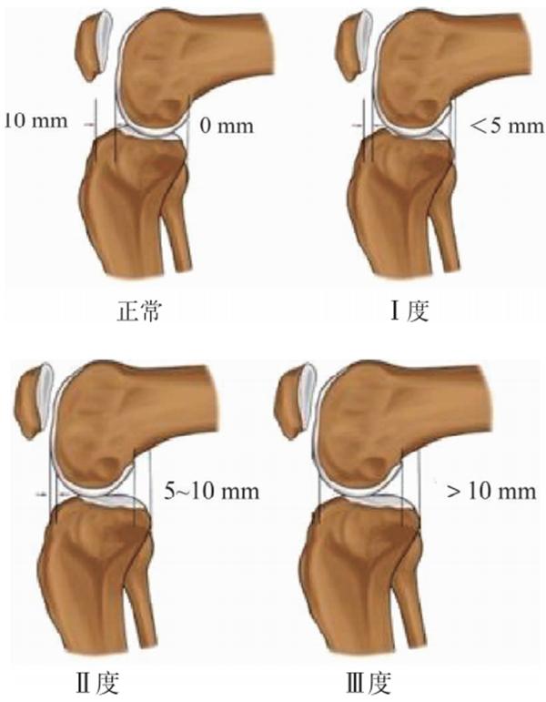 膝关节前交叉韧带损伤怎么治,十字交叉韧带损伤如何解决