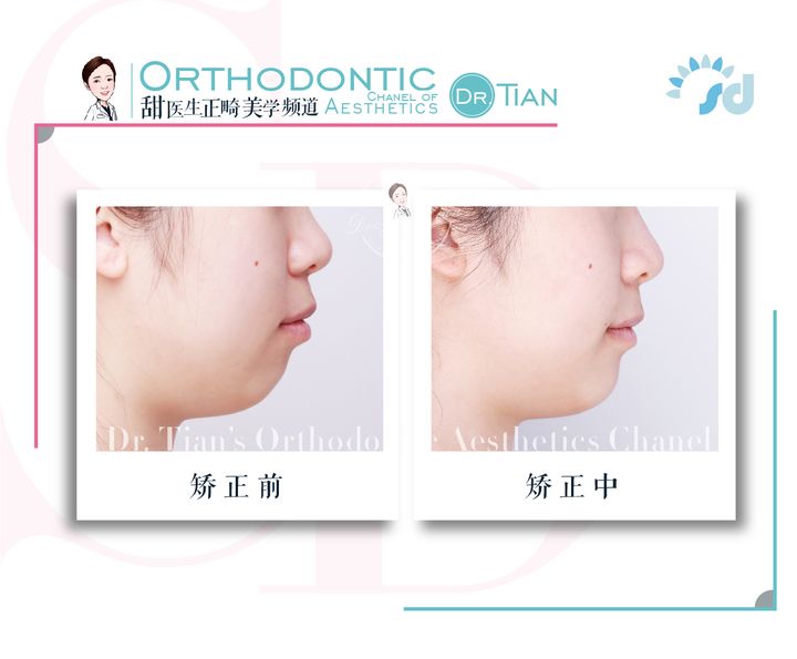 凸嘴下巴后缩拔牙改善有什么坏处,深覆合嘴凸下巴后缩矫正要拔牙吗