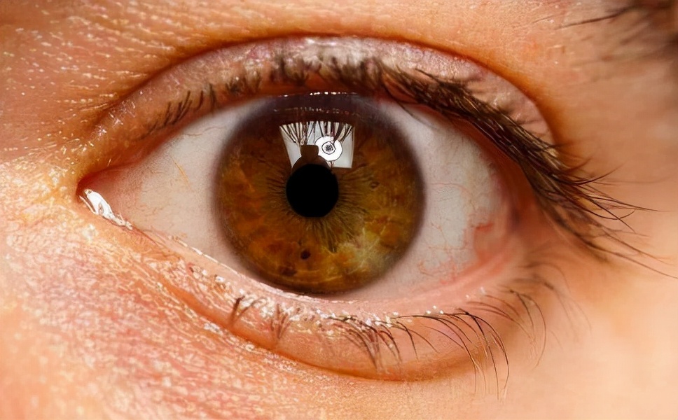 黄斑变性疾病科普知识,黄斑变性一定失明吗