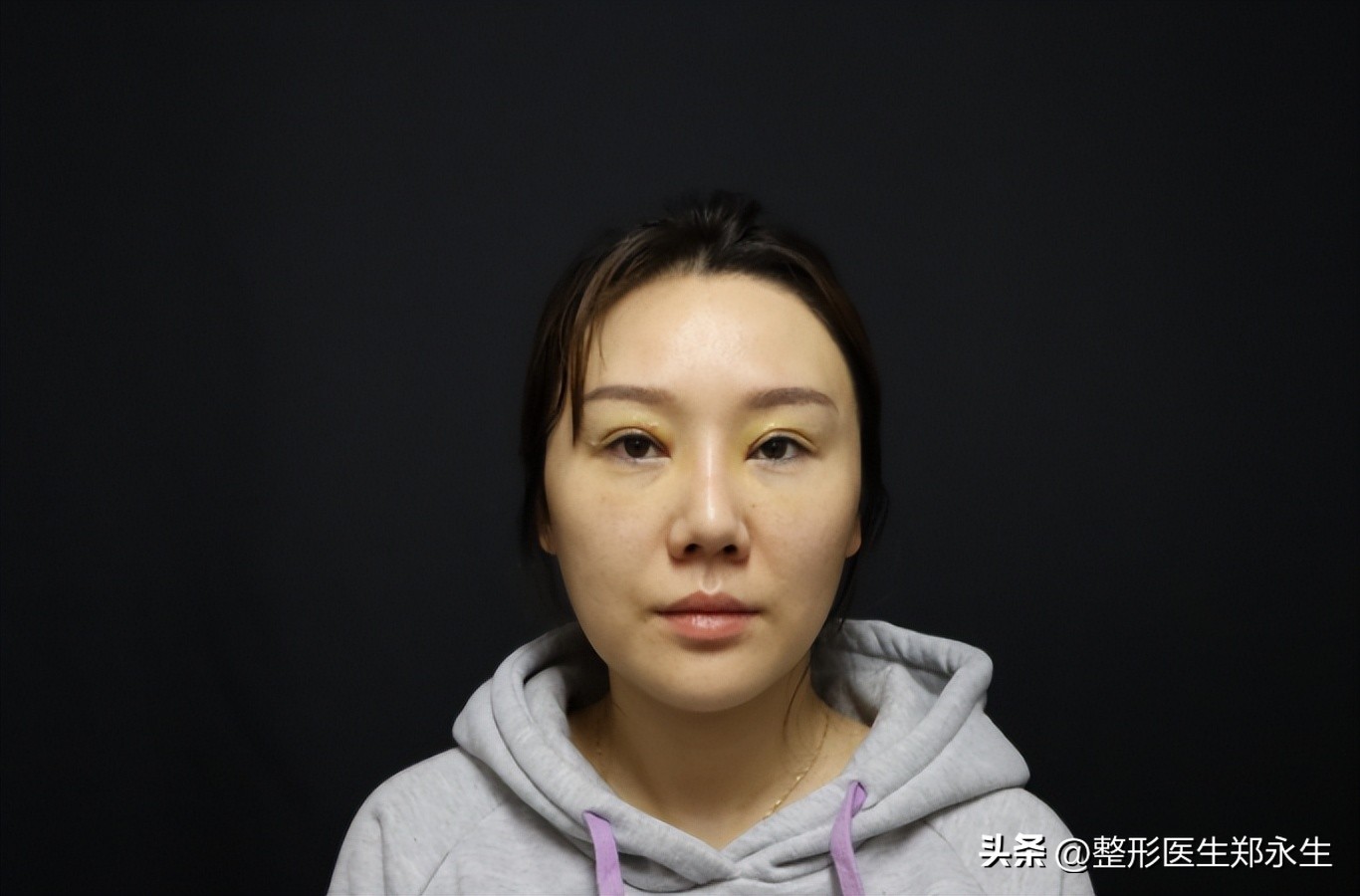 双眼皮修复恢复过程经历真实,修复双眼皮的亲身经历