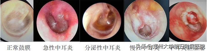 全国爱耳日护耳小知识有哪些,全国爱耳日预防知识