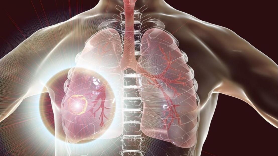 高温治疗是否可以杀死癌细胞,高温杀死癌细胞吗是真的吗