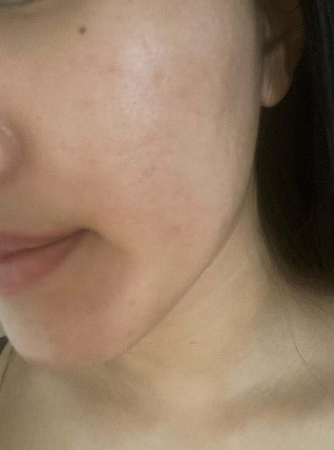 脸上有痘痘用日常方法解决,脸上长了一个痘痘的正确处理方法