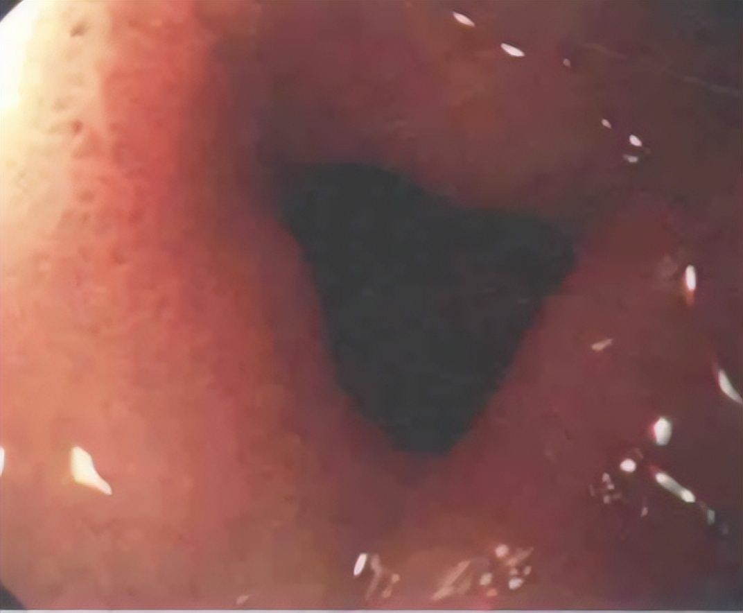 急诊PCI指南,急诊pci治疗费用