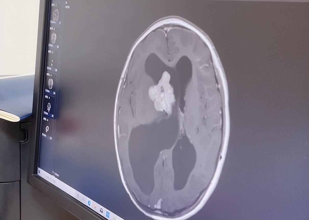 小男孩头骨被敲碎被送去抢救,小男童脑肿瘤