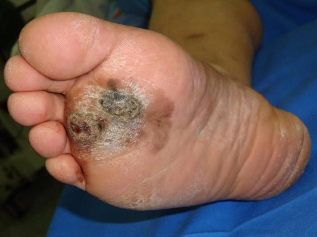 手抠痣有什么危害,手壁痣抠破了癌变概率大吗