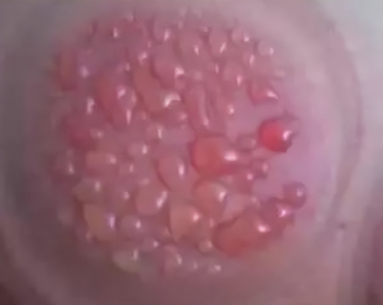 火罐里有水珠怎么回事,火罐拔出水珠是怎么回事