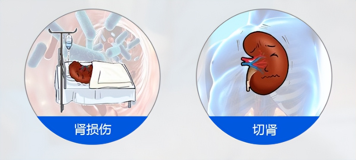 检查有肾结石没有症状应注意什么,肾结石没什么症状怎么办