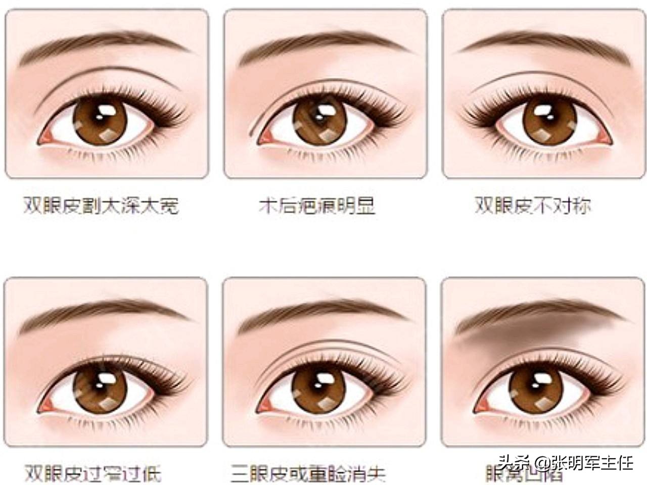 眼皮耷拉、松弛、三角眼，医生建议用两种方法改善
