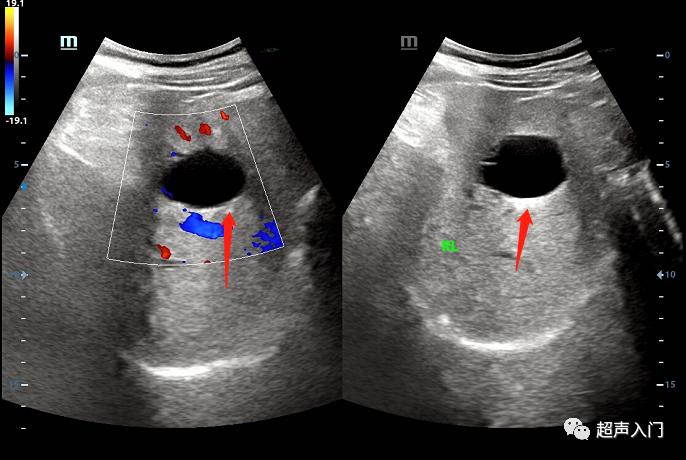 超声学自己能学吗,超声初学者有何窍门