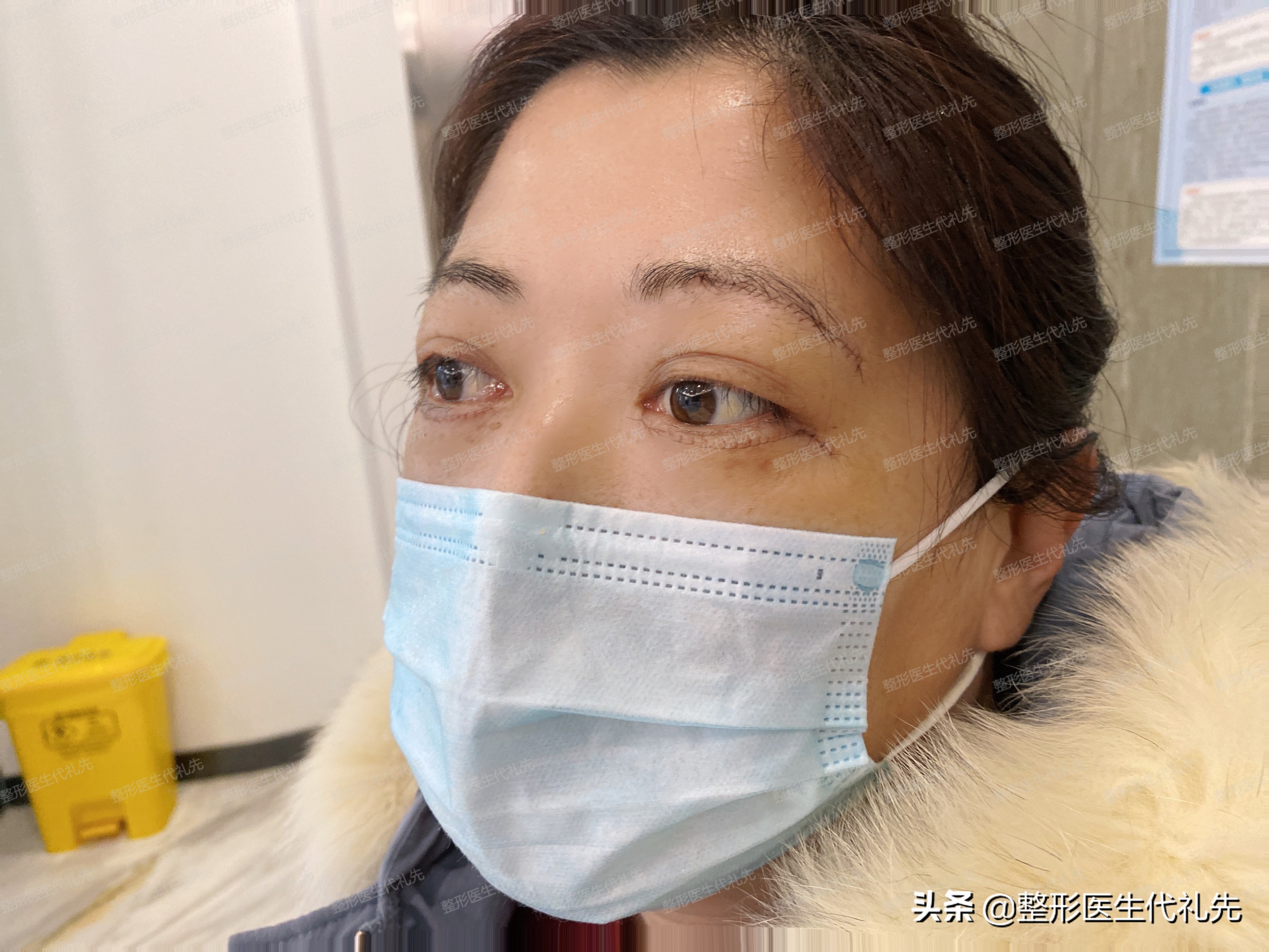 提眉外切眼袋7天后能化妆吗,提眉手术后多久可以做全切眼袋