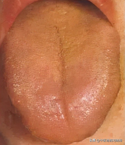 刘主任让病人伸舌头，看的是什么？