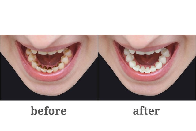 去除牙菌斑最有效的方法,牙菌斑的最有效去除方法