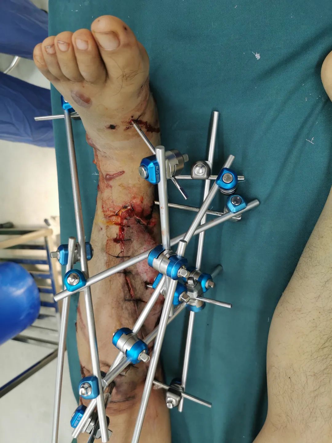 23岁小伙意外车祸致残,男子被车祸压到奇迹生还