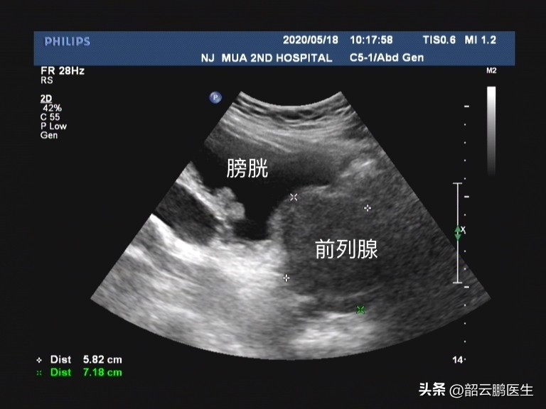 针灸治疗前列腺增生多长时间见效,前列腺增生的用药区别
