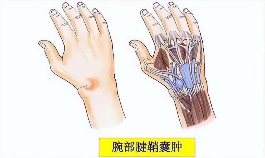 腱鞘囊肿针灸治疗操作方法,腱鞘囊肿可以用银针刺爆吗