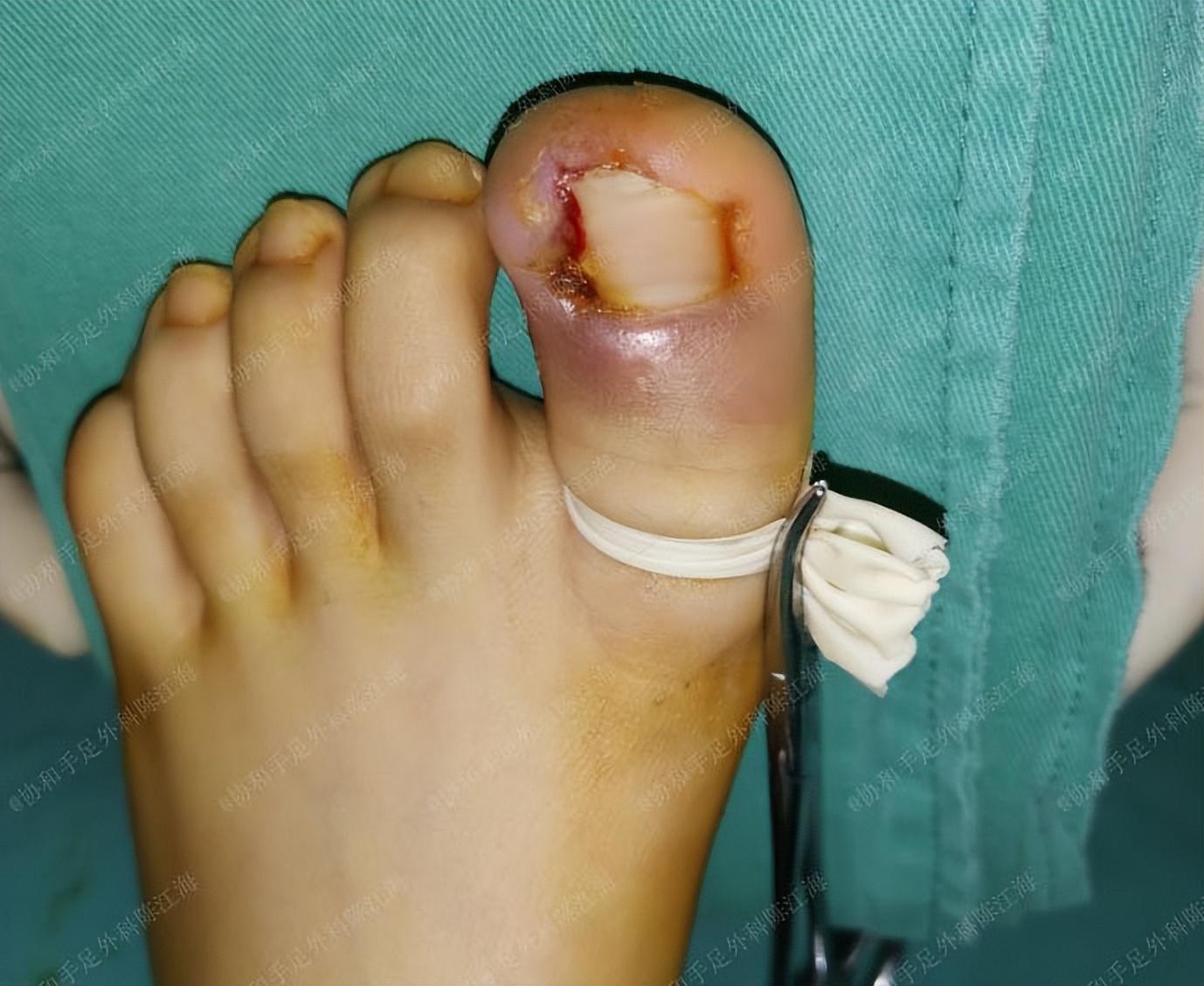 嵌甲炎拔甲还能长出来嘛,指甲根部嵌甲太深拔不出来怎么办