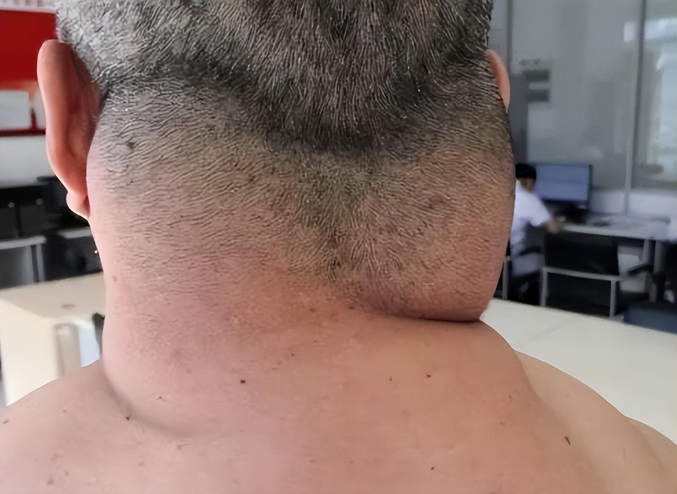 男子一年喝一千斤酒膀子像河马,男子喝酒脖子变河马脖