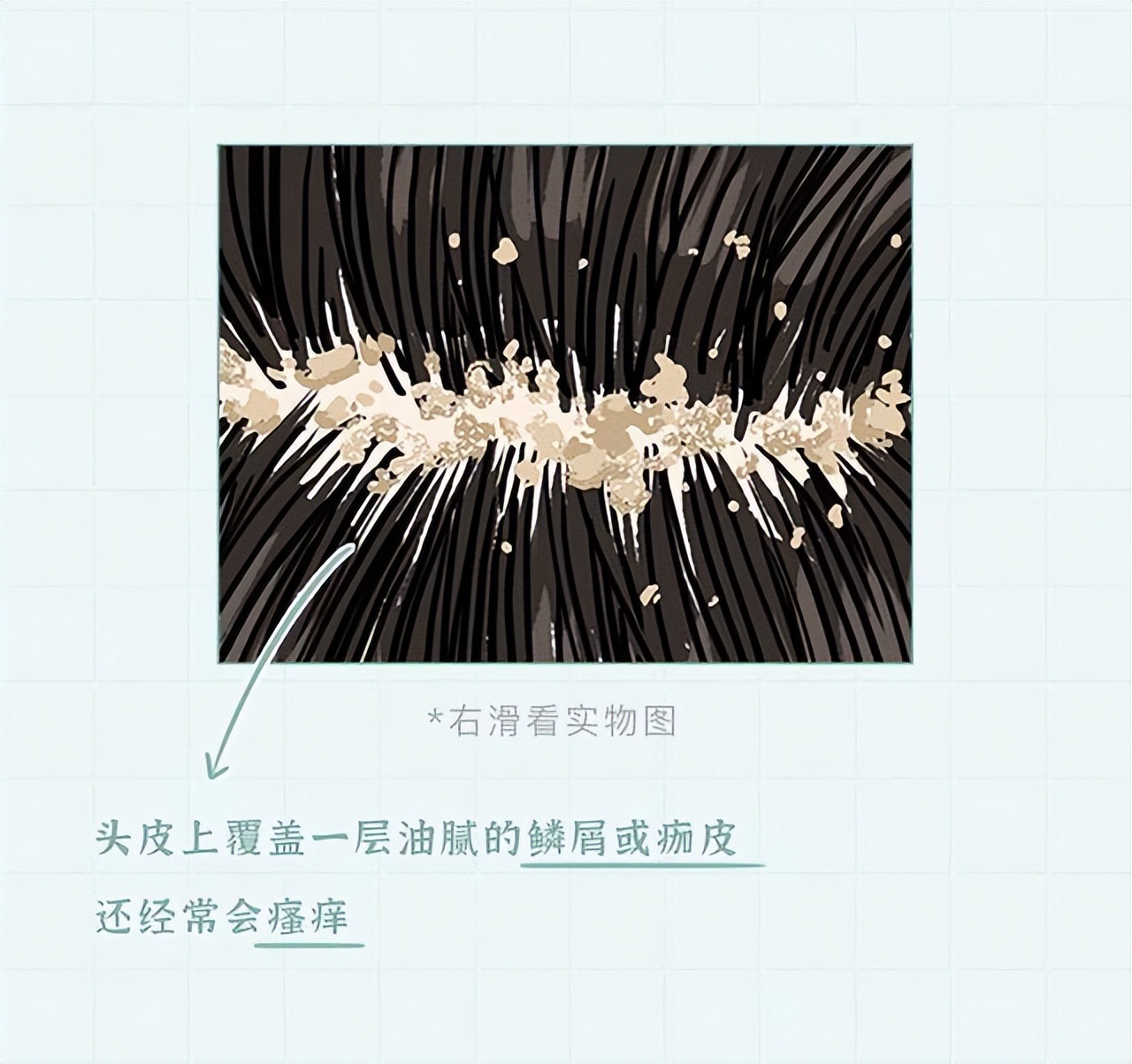 头皮上白色的小颗粒可以抠下来,为什么抓头皮会有白色小颗粒