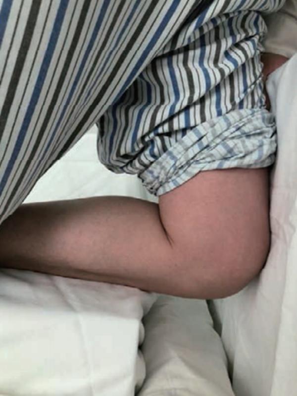 膝关节前交叉韧带损伤怎么治,十字交叉韧带损伤如何解决