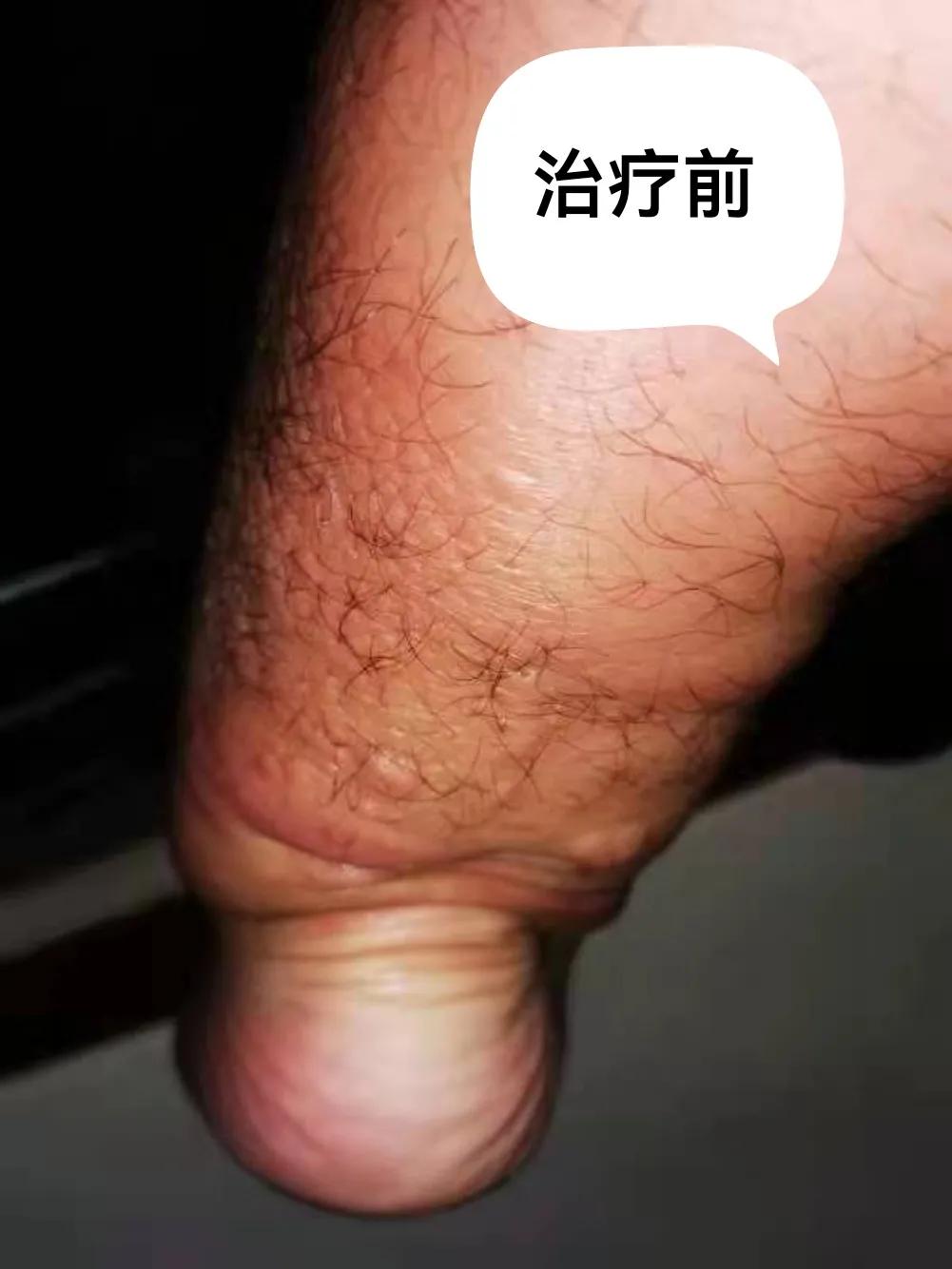 胫前骨粘液性水肿局部治疗,胫前粘液性水肿病例