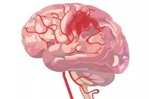 中医对中风的认知和康复方法,脑中风跟癫痫有什么区别