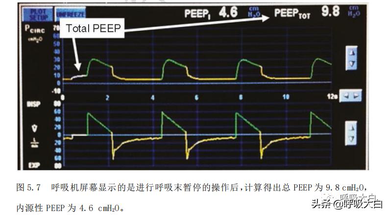 机械通气都是正压通气吗,无创机械通气和有创机械通气区别