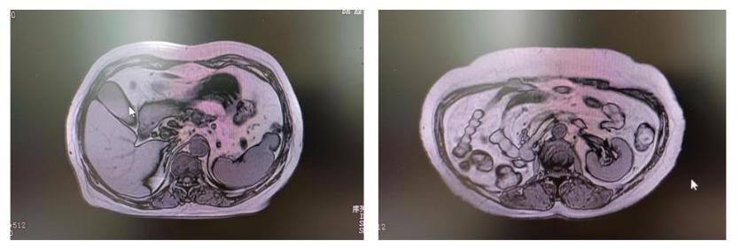 碘125适合多大肿瘤,四川有碘125粒子治疗吗