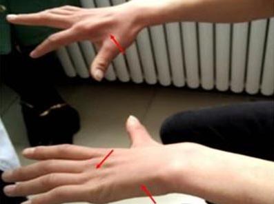 手腕无力手指笨拙虎口萎缩,手臂手掌无力萎缩的症状