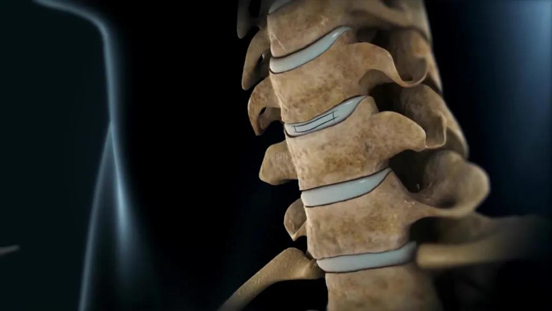 厦门174医院骨科腰椎间盘突出,河南省骨科医院治疗腰椎间盘突出