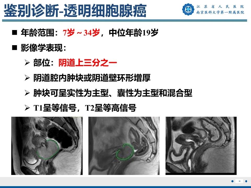 好文分享——《胚胎型横纹肌肉瘤》