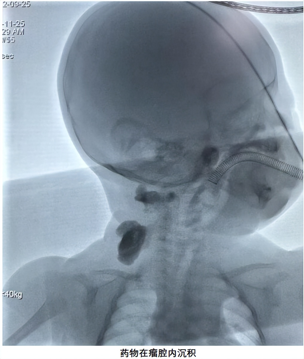 淋巴管瘤微创介入要打麻药吗,淋巴管瘤的微创治疗