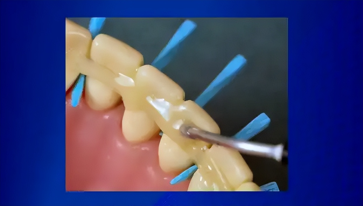 老年人牙齿松动会自动掉吗,老年人洗牙更容易牙齿松动吗