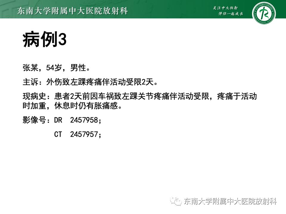 左腓骨下段骨折伴下胫腓联合分离,好文分享深度揭秘