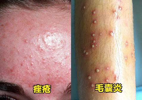 疮和疖子怎么区分,毛囊炎和须疮的区别