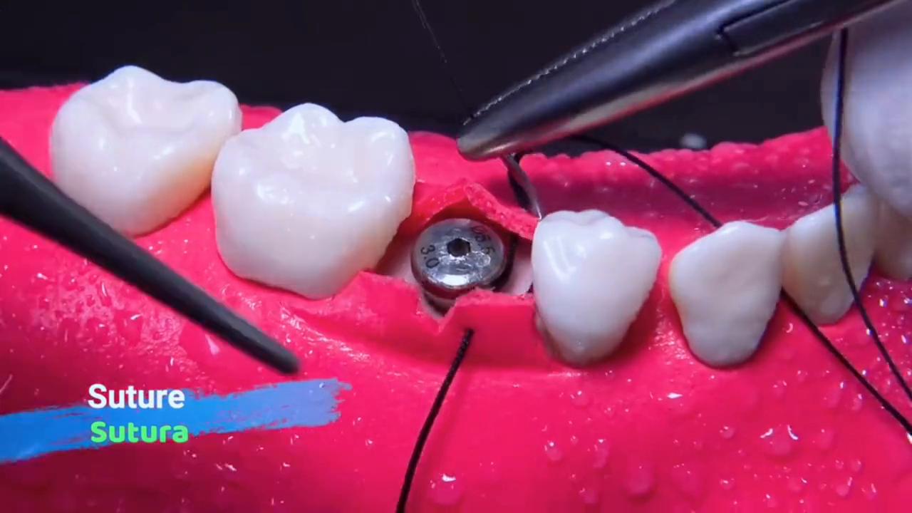 大牙劈裂到种植牙全过程,沉浸式牙齿根管治疗